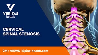 Cervical Spinal Stenosis