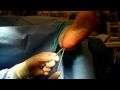 Percutaneous Removal of 7.3mm Cannulated Screw from Calcaneu