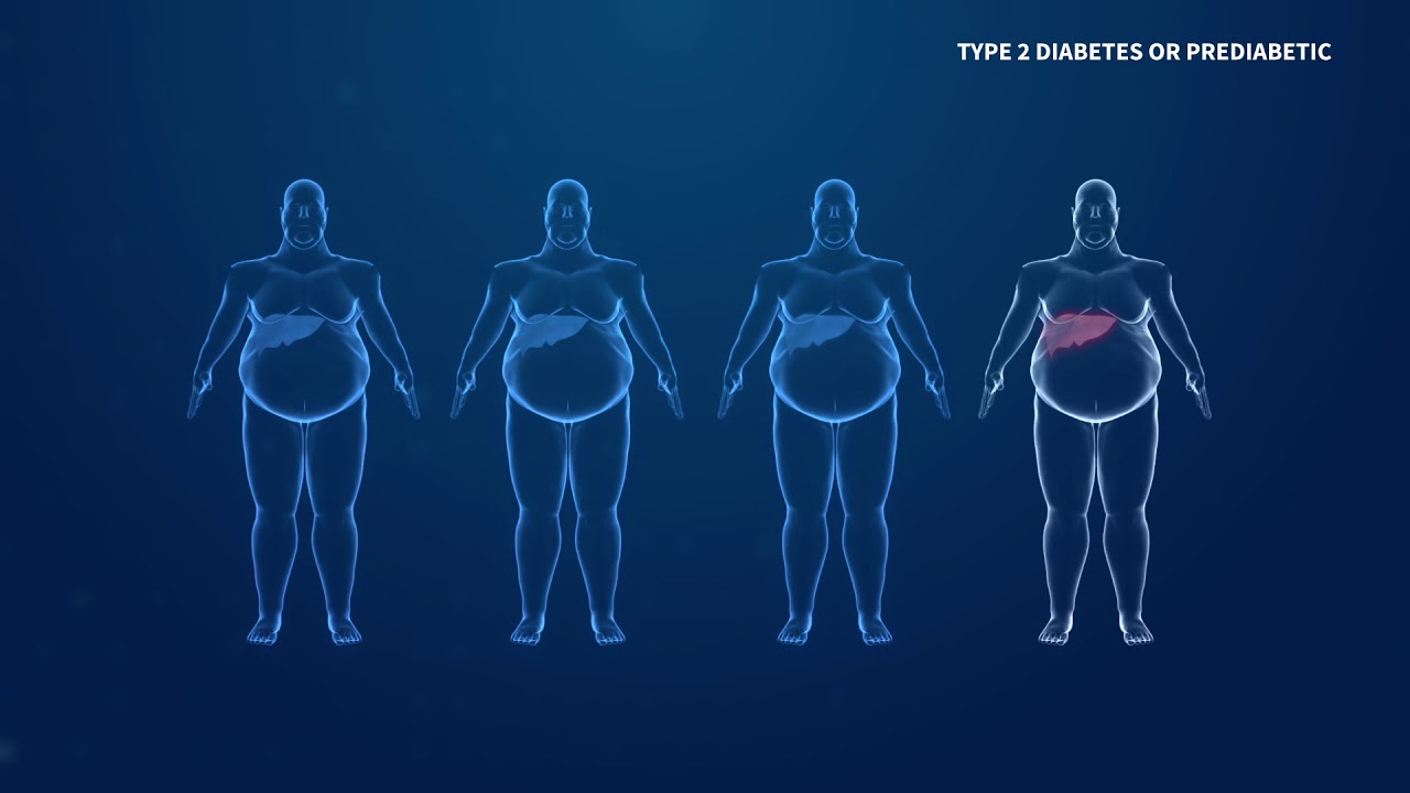 Comorbidity and Liver Disease