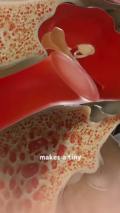 How Myringotomy Surgery is Performed? (3D Animation) #how #surgery #drain #ear #3danimation