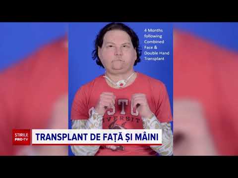 Video: Pentru Prima Dată, Chirurgii Au Reușit Să Efectueze Cu Succes Un Transplant De Față și De Mână