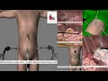 Multiple Hernias - Dr Tulip - Hospital