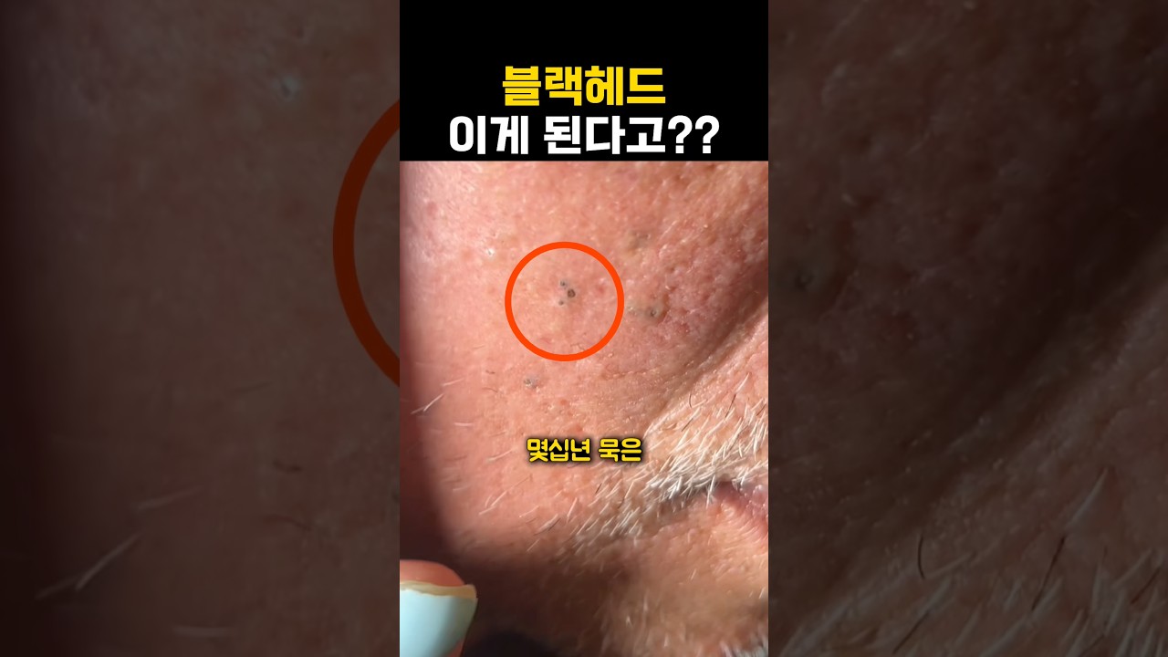 할아버지 블랙헤드 가능?