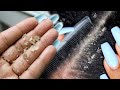 BIG FLAKES! Scalp scratching and picking | Satisfying Dandruff Removal ASMR