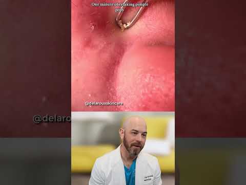 Why You Should Use Gloves for Pimple Popping