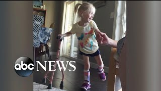 Child with cerebral palsy shows delight taking first steps on her own