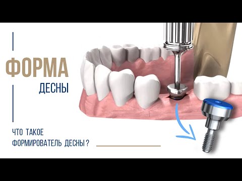 Формирователь десны. Нужен
