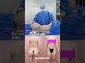 Achieve Your Dream Body With 360 Liposuction And Brazilian Butt Lift Transformation Achieve Your Dream Body With 360 Liposuction And Brazilian Butt Lift Transformation