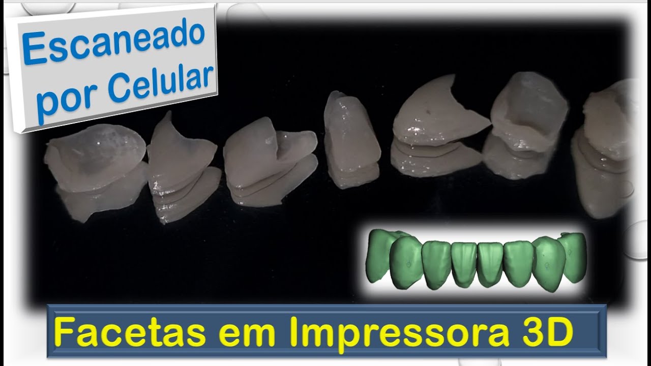 Como Fazer Facetas e Coroas em Impressora 3D / 3D printing of veneers and Crowns
