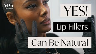 Natural Lip Filler Procedure  Before & After of Subtle and Delicate Lip Modification