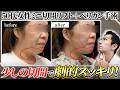 【劇的若返り】リスクは最小限｜ミニ切開リフトとペリカン手術