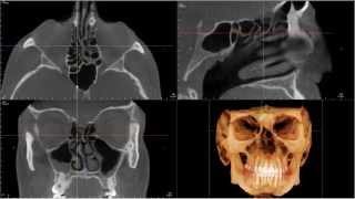 Cbct Interpretation Paranasal Sinuses Movie Sneak Peak
