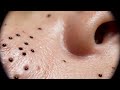 #PoreZen #BlackheadRemoval #PimplePopping #ASMRBlackhead 73