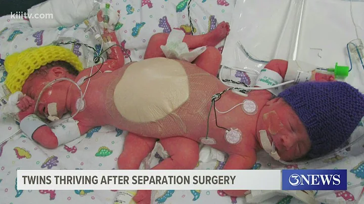 Twins thriving 5 years after separation surgery at...