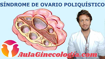 ¿Puede un ginecólogo saber si tienes el síndrome de ovario poliquístico?