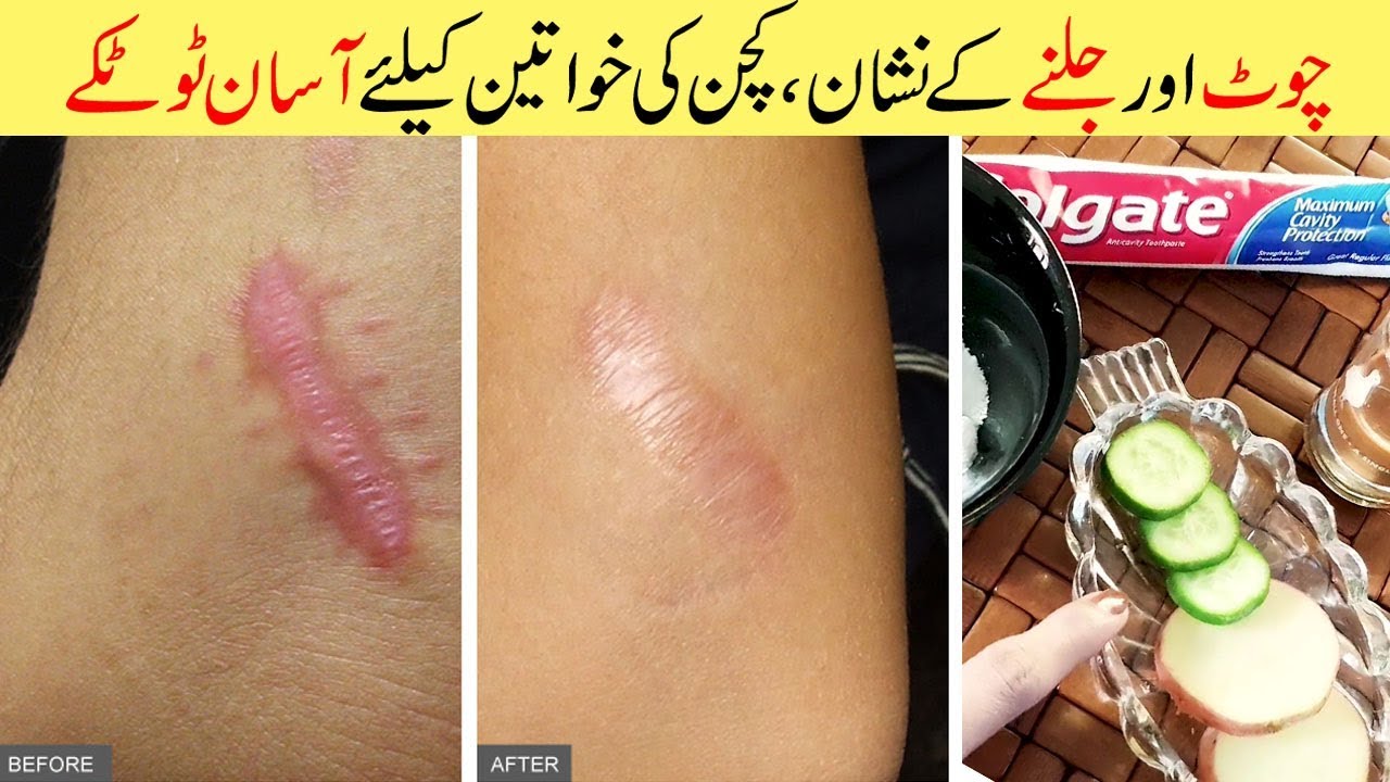 Get Rid of Burn Scars (Marks) Full Treatment Spot Removal ...