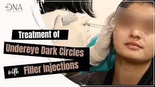 Undereye Filler Injections Dark Undereye Undereye Dark Circles Dr. Priyanka Reddy