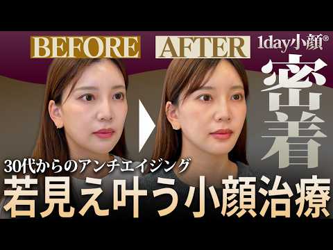 写真で気になったフェイスラインを改善｜顎下脂肪吸引のリアル密着