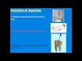 Prof. Hussain Al-Huwaizi-Bypass of fractured root canal instrument