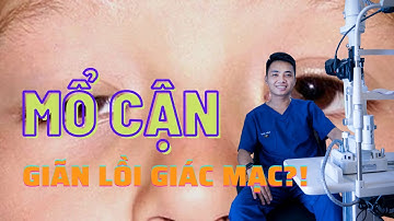 Có phải phẫu thuật Lasik xong sẽ bị giãn lồi giác mạc? Giãn lồi giác mạc có nguy hiểm không?