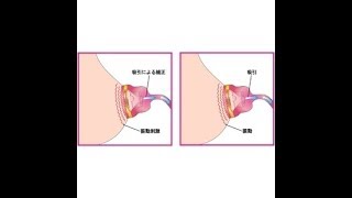 【女性の悩みを解決】仮性の陥没乳首を治すには