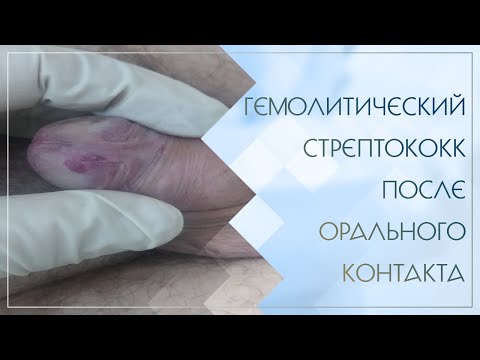 Гемолитический стрептококк после орального контакта. Клинический случай №6