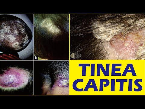 Video: Infeksi Jamur (Dermatophytosis) Pada Kulit, Rambut, Dan Kuku Pada Musang