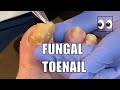 THICK FUNGAL Toenail Not Cut in 6 months!