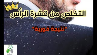 مشكل قشرة الرأس و علاجه منزليا ?