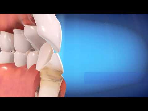 Invisalign Straight Talk About Crooked Teeth | Dragon Dental Group | Oakland, Alameda, CA