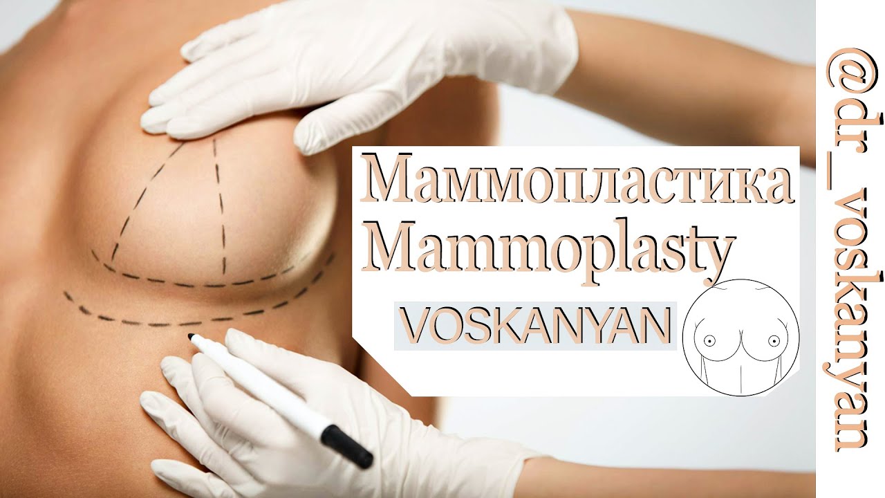 Увеличение груди. Маммопластика - все что нужно знать. Основы маммопластики