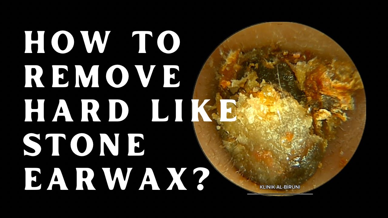 Ear Rocks Treatment HOW TO REMOVE HARD LIKE STONE EARWAX? (4K 60FPS) - YouTube