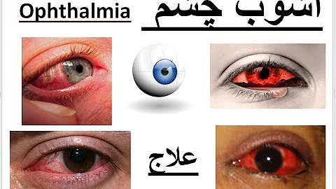 Ophthalmia - Home remedies to cure Ophthalmia