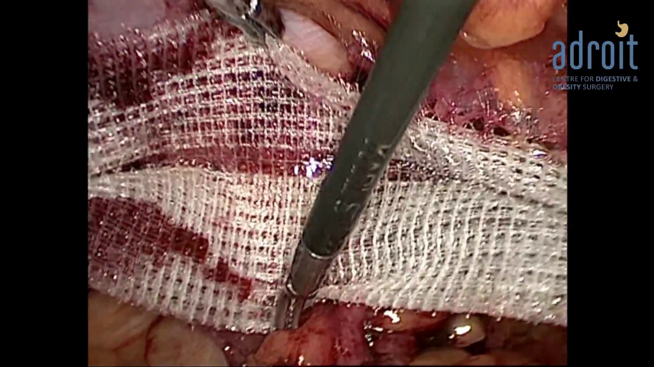 acid reflux during pregnancy Laparoscopic Inguinal Hernia Surgery (Bilateral TEP )