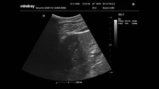 видео: Ультразвуковая диагностика (УЗИ). Доктор Иогансен. Видеопримеры. Выпуск 4. Опухоли печени. картинка: Ультразвуковая диагностика (УЗИ). Доктор Иогансен. Видеопримеры. Выпуск 4. Опухоли печени.