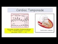 12DaysinMarch, Tamponade and Constrictive Pericarditis for USMLE Step One (Part II)