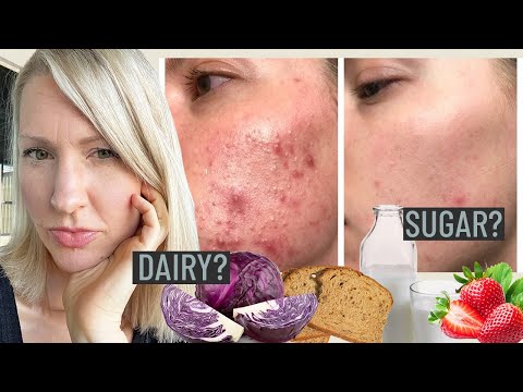 Dietitian FACT CHECKS the Hormonal Acne Diet: Is Food Causing Your Acne?!
