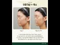 #더비비성형외과 이마거상과 축소를 동시에 진행