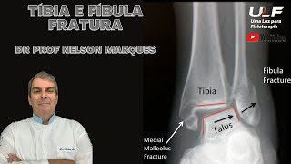 Tíbia E Fíbula - Fratura - Dr. Prof. Nelson Marques