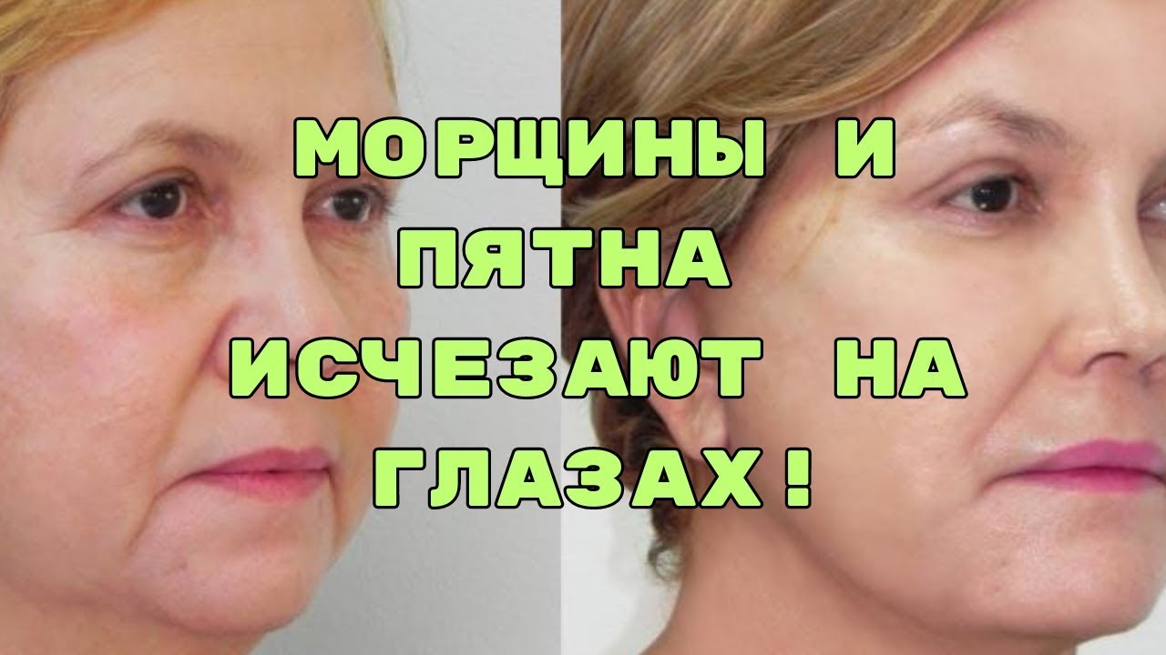 Возьмите 1 Картофель и УБЕРИТЕ ВСЕ МОРЩИНЫ ,Отёки ,синяки и тёмные круги под глазами