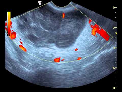 PID Toa Ultrasound 9;2 .wmv - YouTube