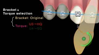 Clinical tips for substitution of congenitally missing lateral incisors｜【Chris Chang Ortho】CC441