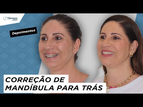 DEPOIMENTO CIRURGIA ORTOGNÁTICA | Classe II