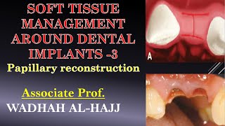 34-Soft tissue management around implants-3-Papillary reconstruction.wadhah implantology lectures. screenshot 5