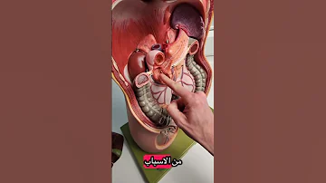تشريح المرارة والقنوات الصفراوية وكيفية حدوث حصوات المرارة د عبدالحكيم حمدان 