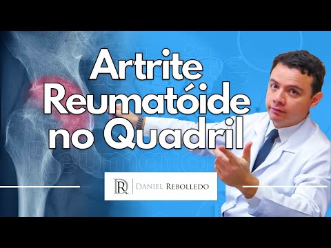 Vídeo: 3 maneiras de tratar a artrite reumatóide nos quadris