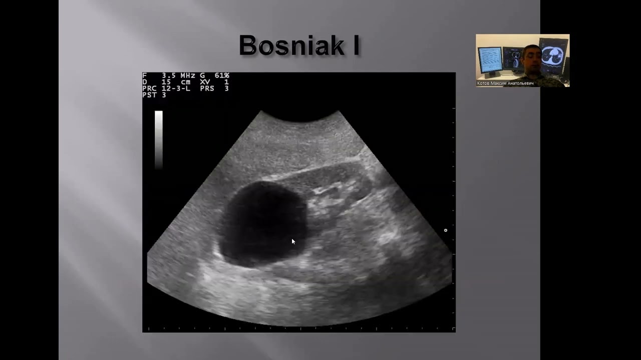 УЗД заболеваний почек