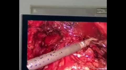 Phẫu thuật nội soi cắt toàn bộ tuyến tiền liệt: Thì nối niệu đạo sau với cổ bàng quang