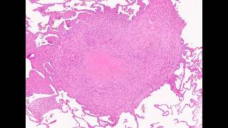 Pathology of Silicosis