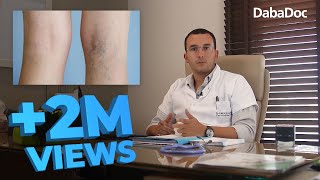التقنيات الجديدة لعلاج دوالي الساقين مع الدكتور حمزة بنجلون